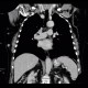 Metastasis of malignant melanoma into skin: CT - Computed tomography